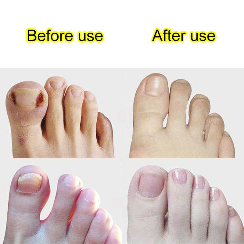 नाखून क्लीपर्स को तह